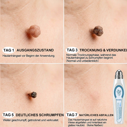 𝐎𝐟𝐟𝐢𝐳𝐢𝐞𝐥𝐥𝐞𝐫 𝐌𝐚𝐫𝐤𝐞𝐧𝐬𝐡𝐨𝐩 |🍋🌙Remifa ® 𝟕-𝑻𝒂𝒈𝒆 𝑭𝒍𝒆𝒄𝒌𝒆𝒏 & 𝑯𝒂𝒖𝒕𝒘𝒖𝒄𝒉𝒔𝒕𝒆𝒏 𝑬𝒏𝒕𝒇𝒆𝒓𝒏𝒆𝒓 (Schmerzfreier Roller, keine Narben nach der Anwendung)
