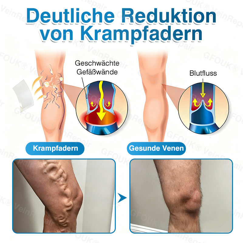 🇩🇪👨‍⚕️✅GFOUK® VeinRepair Mikronadel-Pflasterrolle⚡Sofortige Linderung, langfristige Ergebnisse