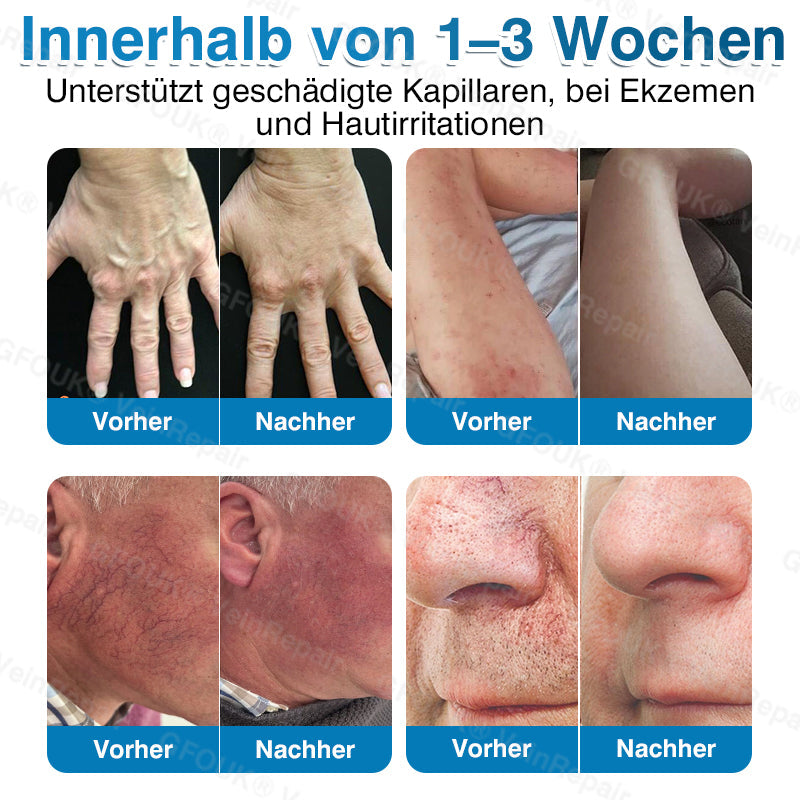 🇩🇪👨‍⚕️✅GFOUK® VeinRepair Mikronadel-Pflasterrolle⚡Sofortige Linderung, langfristige Ergebnisse
