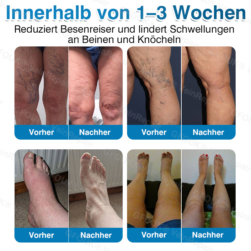 🇩🇪👨‍⚕️✅GFOUK® VeinRepair Mikronadel-Pflasterrolle⚡Sofortige Linderung, langfristige Ergebnisse