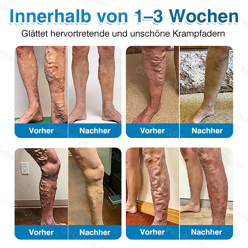 🇩🇪👨‍⚕️✅GFOUK® VeinRepair Mikronadel-Pflasterrolle⚡Sofortige Linderung, langfristige Ergebnisse